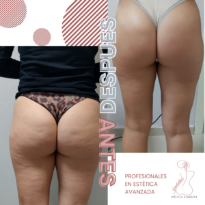 diatermia